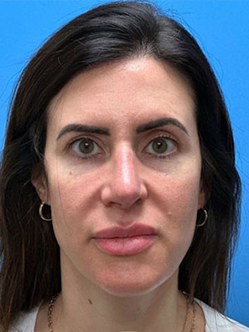 Rhinoplasty Before & After Gallery - Patient 124520 - Image 4