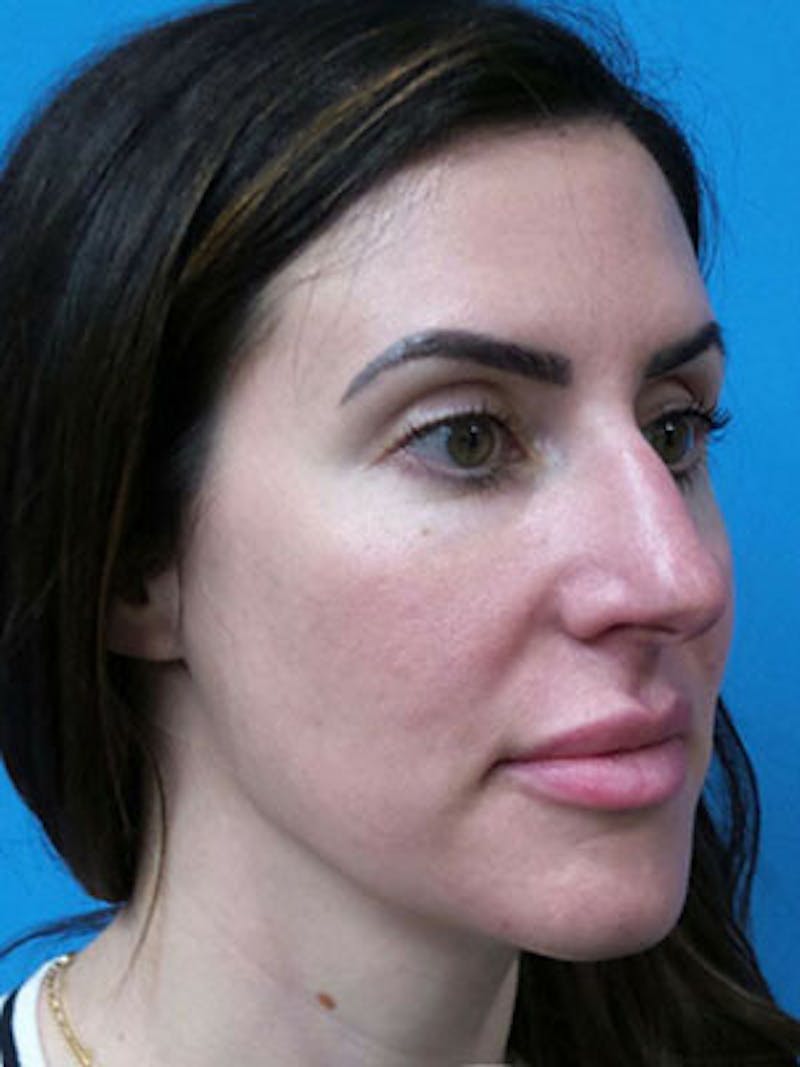 Rhinoplasty Before & After Gallery - Patient 124520 - Image 5