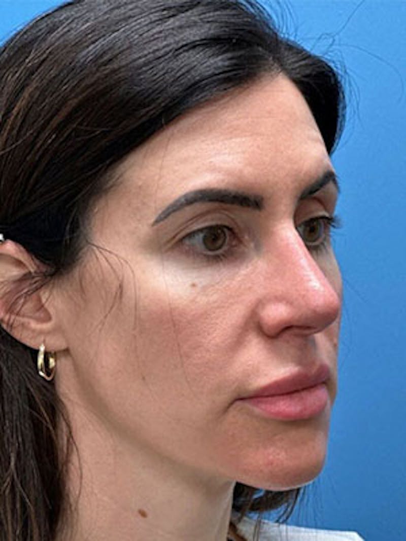 Rhinoplasty Before & After Gallery - Patient 124520 - Image 6