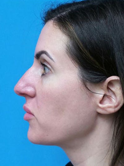 Rhinoplasty Before & After Gallery - Patient 124520 - Image 1