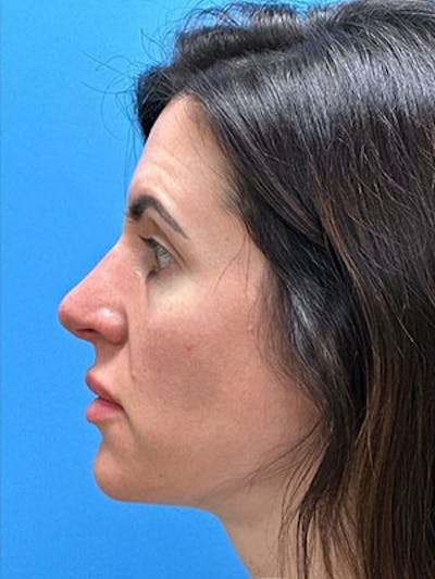 Rhinoplasty Before & After Gallery - Patient 124520 - Image 2