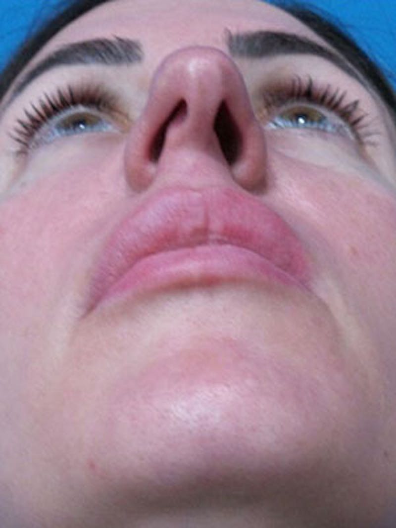 Rhinoplasty Before & After Gallery - Patient 124520 - Image 7
