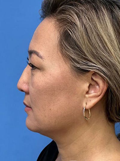 Rhinoplasty Before & After Gallery - Patient 756604 - Image 1