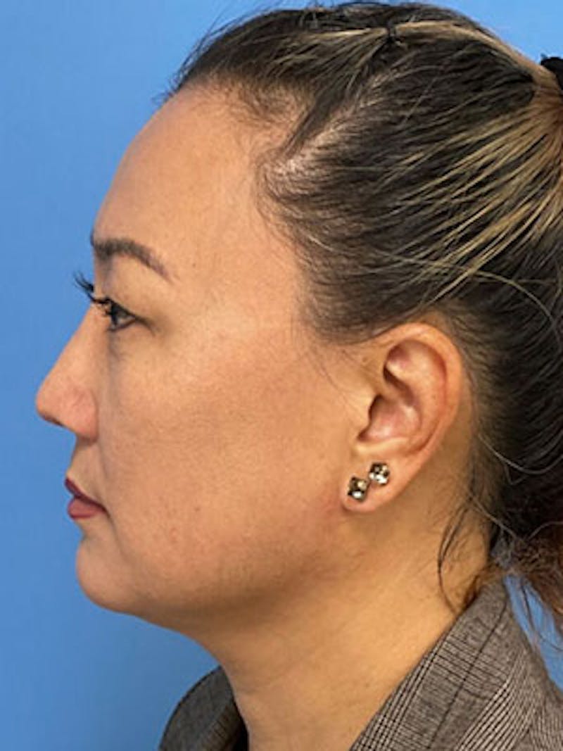 Rhinoplasty Before & After Gallery - Patient 756604 - Image 2