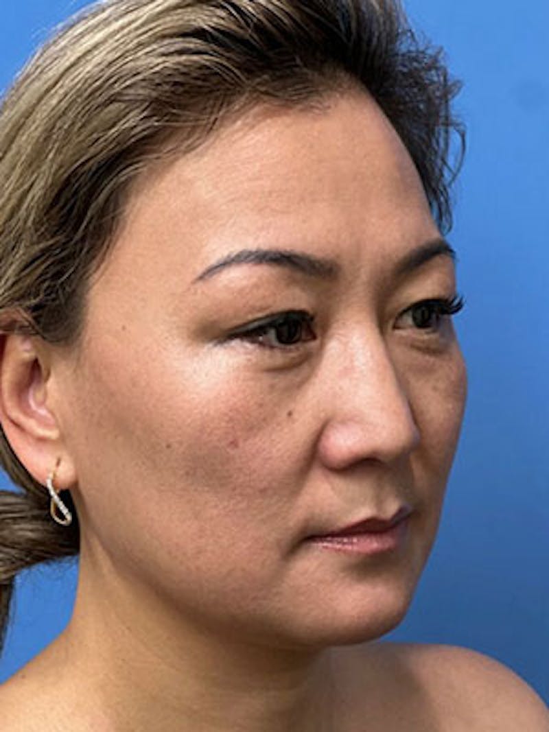 Rhinoplasty Before & After Gallery - Patient 756604 - Image 3