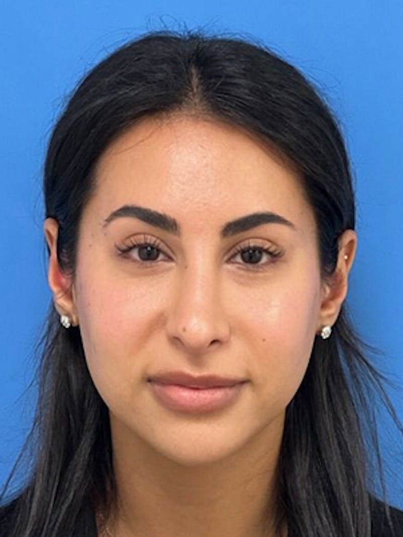 Rhinoplasty Before & After Gallery - Patient 271913 - Image 4