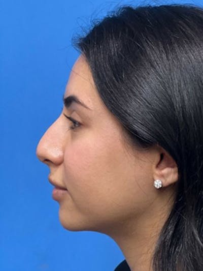 Rhinoplasty Before & After Gallery - Patient 271913 - Image 1