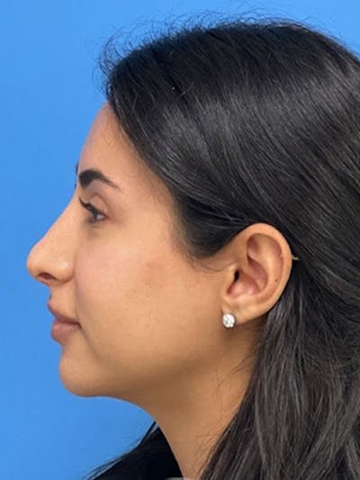 Rhinoplasty Before & After Gallery - Patient 271913 - Image 2
