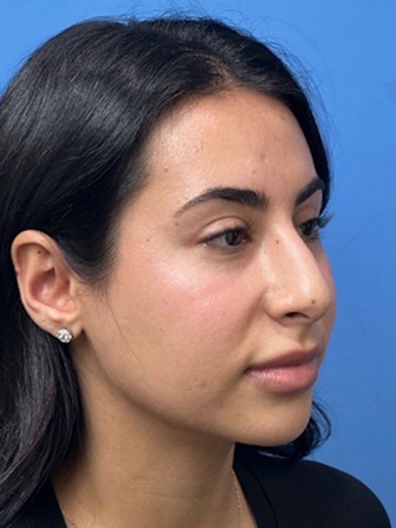Rhinoplasty Before & After Gallery - Patient 271913 - Image 5