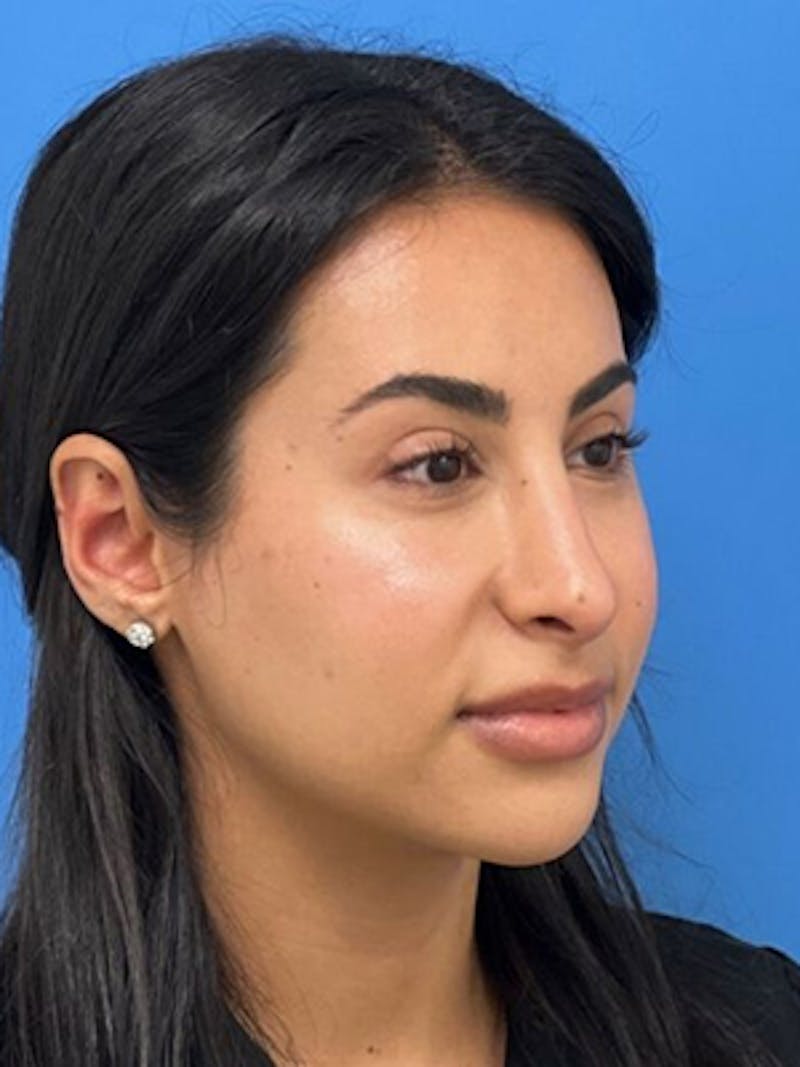 Rhinoplasty Before & After Gallery - Patient 271913 - Image 6