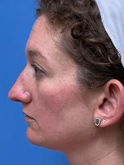 Rhinoplasty Before & After Gallery - Patient 251700 - Image 1