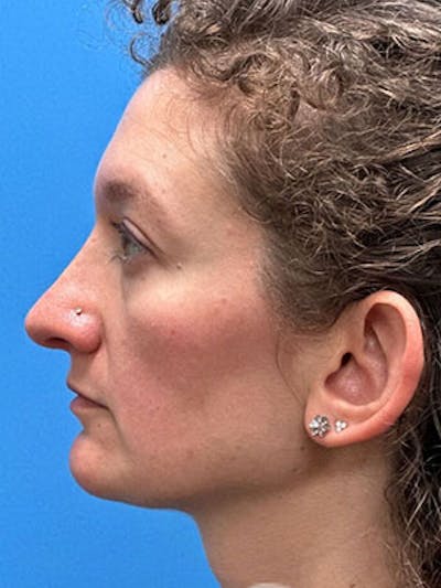 Rhinoplasty Before & After Gallery - Patient 251700 - Image 2