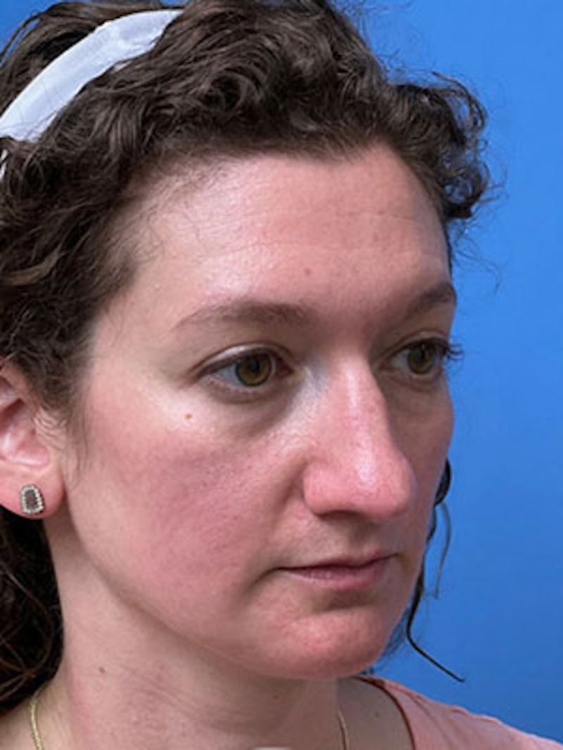 Rhinoplasty Before & After Gallery - Patient 251700 - Image 3