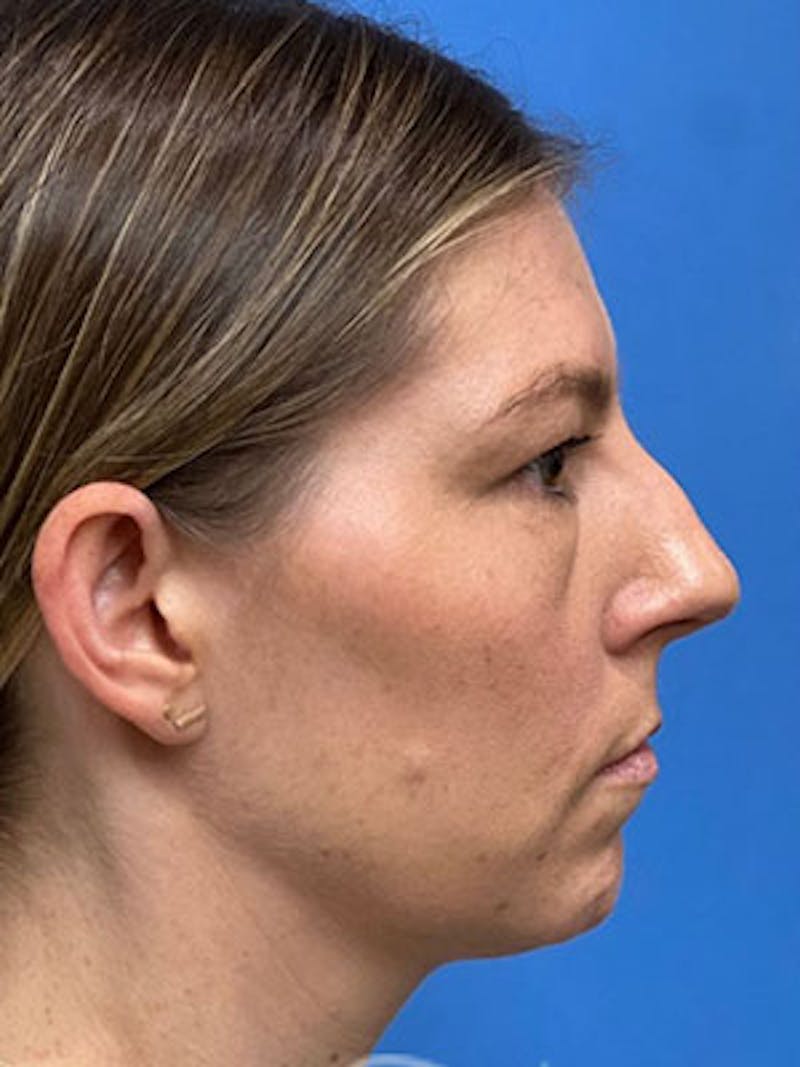 Rhinoplasty Before & After Gallery - Patient 323352 - Image 1