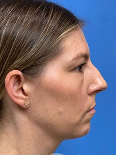 Rhinoplasty Before & After Gallery - Patient 323352 - Image 1