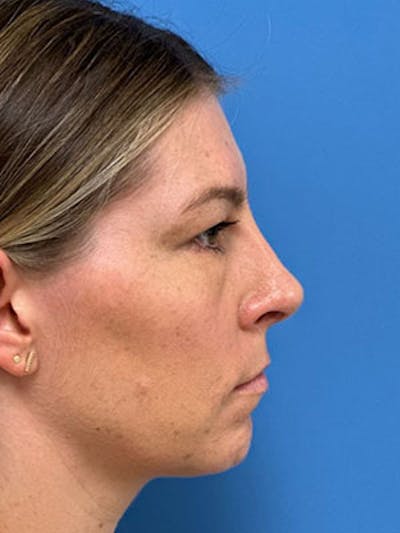 Rhinoplasty Before & After Gallery - Patient 323352 - Image 2