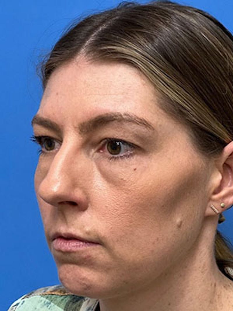 Rhinoplasty Before & After Gallery - Patient 323352 - Image 5