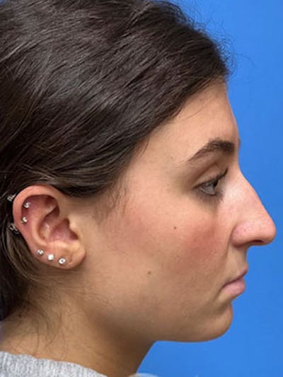 Rhinoplasty Before & After Gallery - Patient 170124 - Image 1