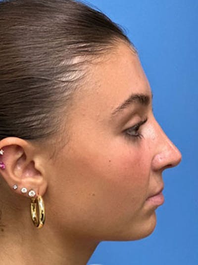 Rhinoplasty Before & After Gallery - Patient 170124 - Image 2