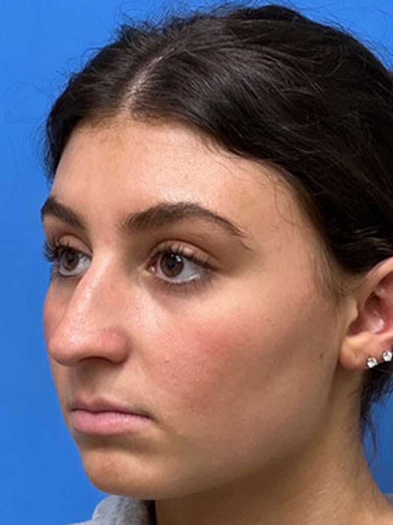 Rhinoplasty Before & After Gallery - Patient 170124 - Image 6