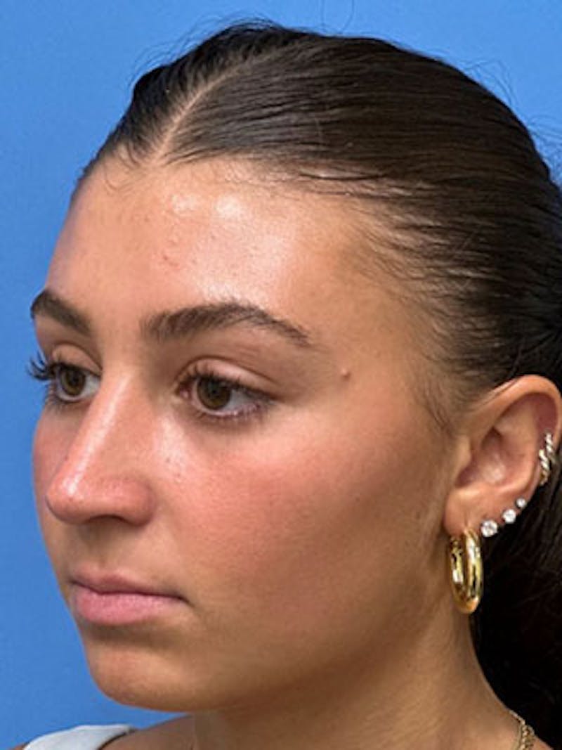 Rhinoplasty Before & After Gallery - Patient 170124 - Image 5