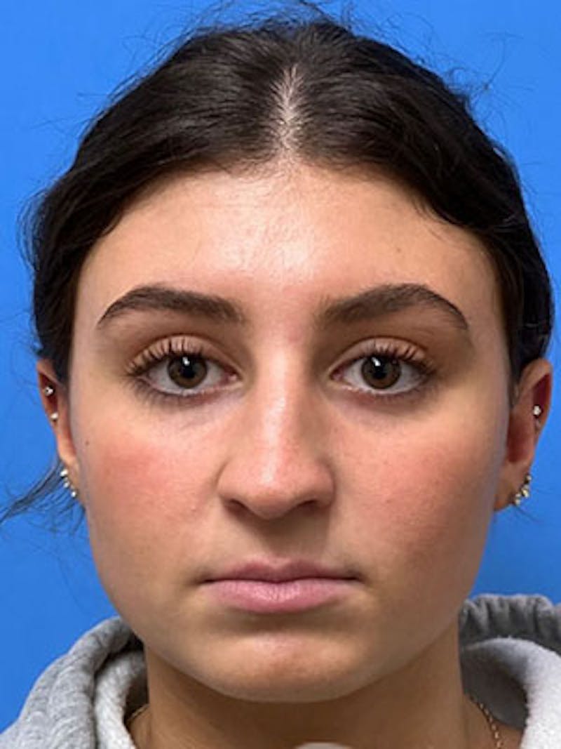 Rhinoplasty Before & After Gallery - Patient 170124 - Image 4