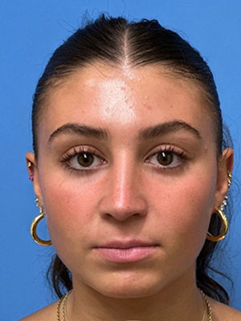 Rhinoplasty Before & After Gallery - Patient 170124 - Image 3