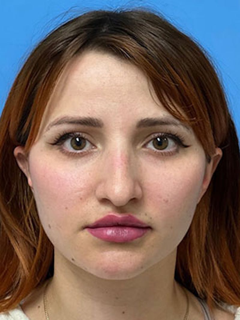 Rhinoplasty Before & After Gallery - Patient 379778 - Image 3