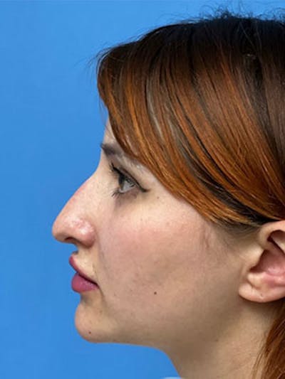 Rhinoplasty Before & After Gallery - Patient 379778 - Image 1