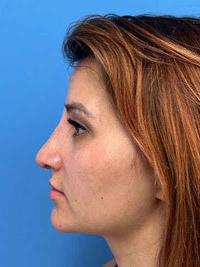 Rhinoplasty Before & After Gallery - Patient 379778 - Image 2