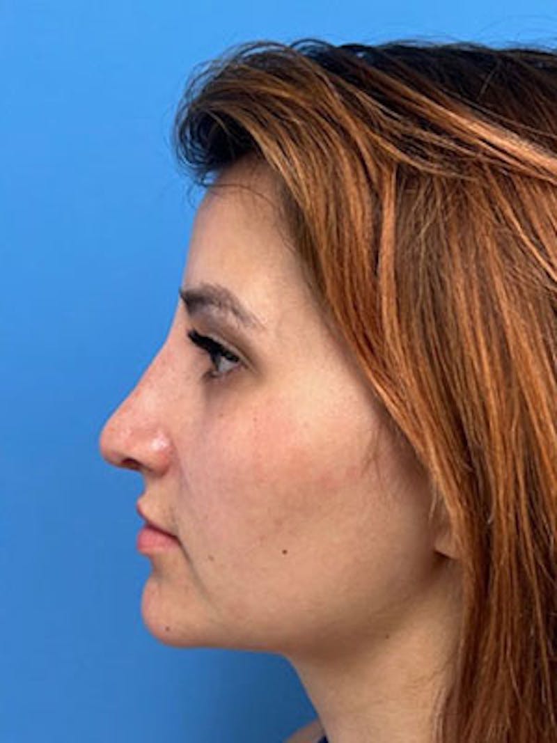 Rhinoplasty Before & After Gallery - Patient 379778 - Image 2
