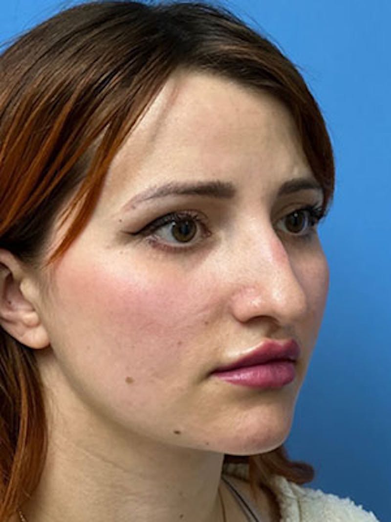 Rhinoplasty Before & After Gallery - Patient 379778 - Image 5