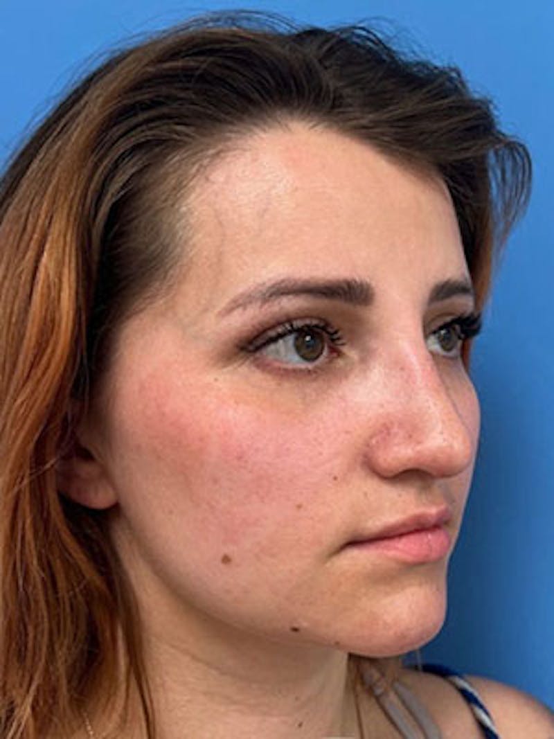 Rhinoplasty Before & After Gallery - Patient 379778 - Image 6