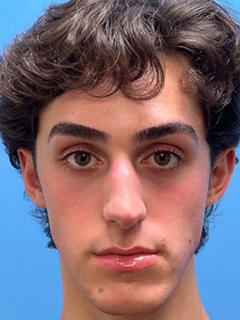 Rhinoplasty Before & After Gallery - Patient 206207 - Image 3