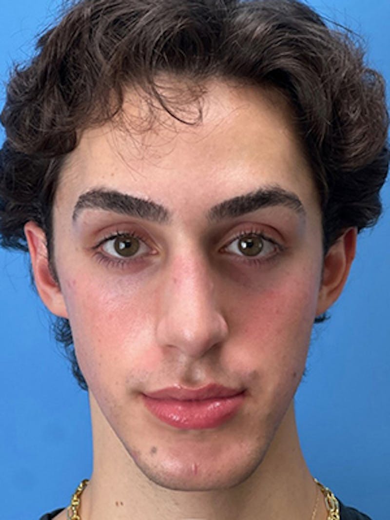 Rhinoplasty Before & After Gallery - Patient 206207 - Image 4