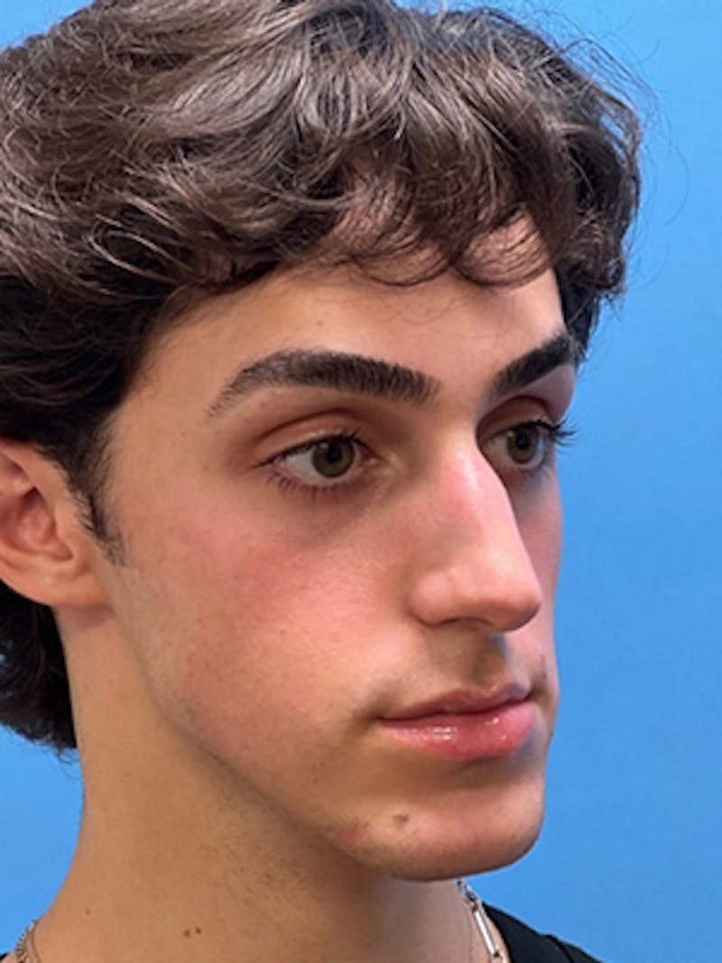 Rhinoplasty Before & After Gallery - Patient 206207 - Image 5