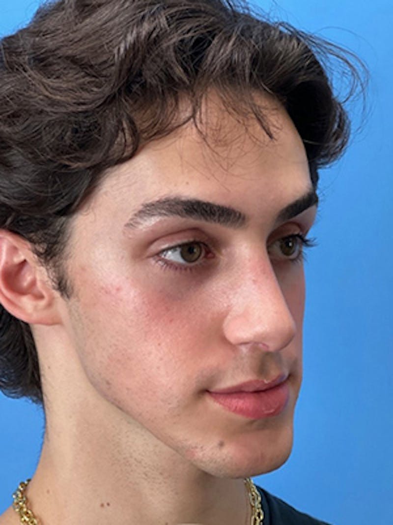 Rhinoplasty Before & After Gallery - Patient 206207 - Image 6