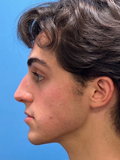 Rhinoplasty Before & After Gallery - Patient 206207 - Image 1