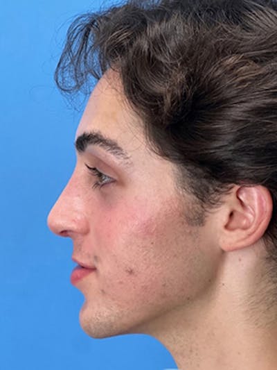 Rhinoplasty Before & After Gallery - Patient 206207 - Image 2