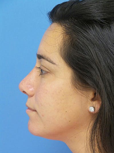 Rhinoplasty Before & After Gallery - Patient 989187 - Image 2