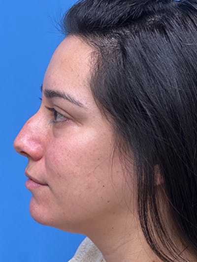 Rhinoplasty Before & After Gallery - Patient 989187 - Image 1