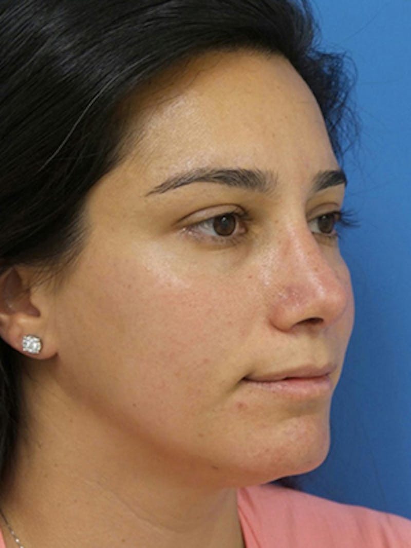 Rhinoplasty Before & After Gallery - Patient 989187 - Image 4