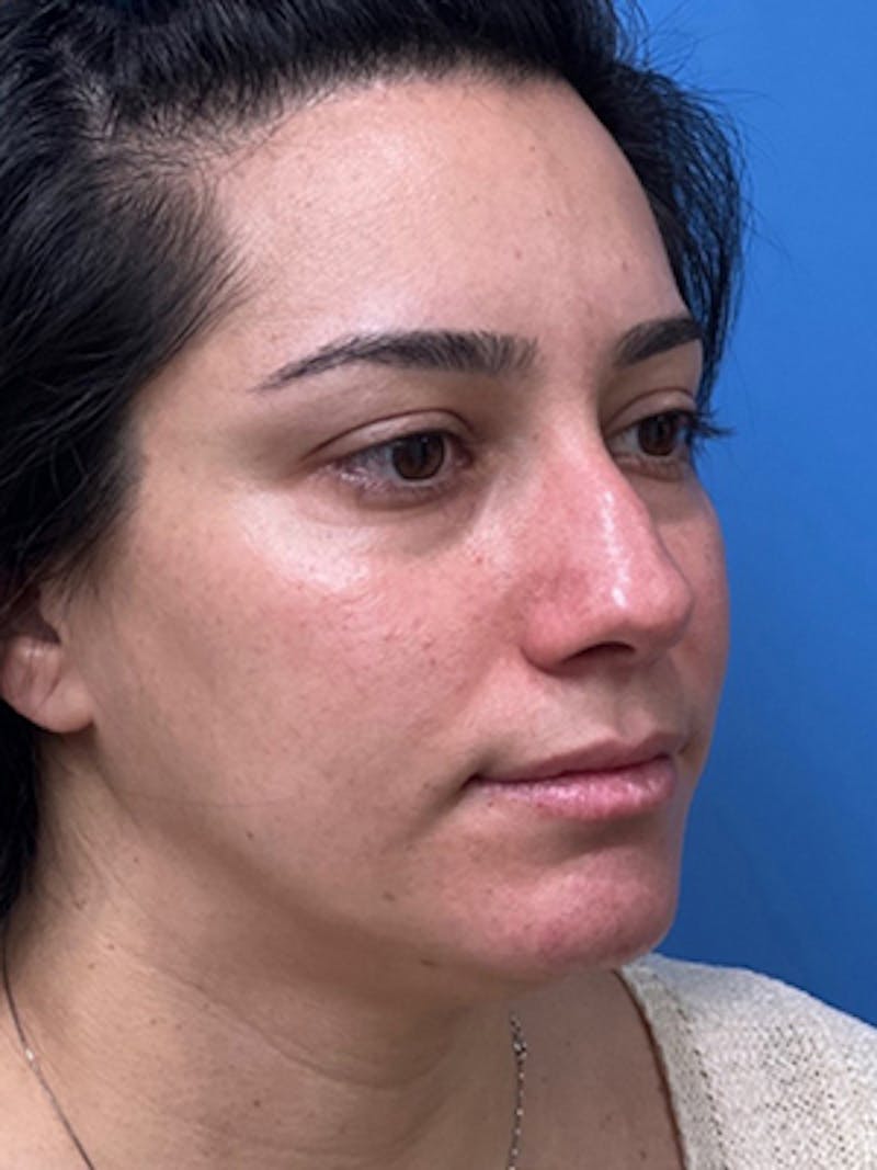 Rhinoplasty Before & After Gallery - Patient 989187 - Image 3