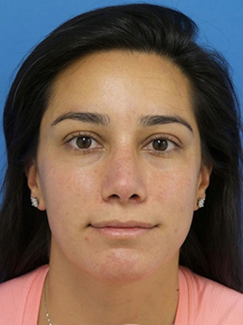 Rhinoplasty Before & After Gallery - Patient 989187 - Image 6