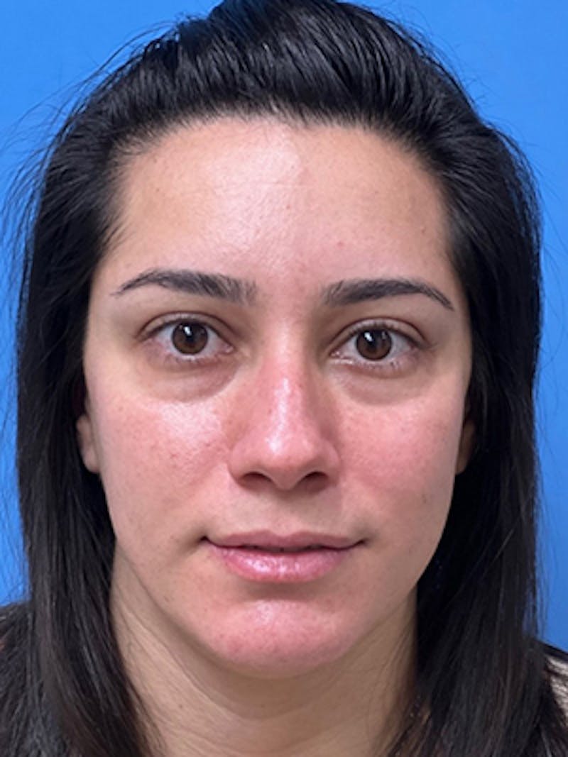 Rhinoplasty Before & After Gallery - Patient 989187 - Image 5