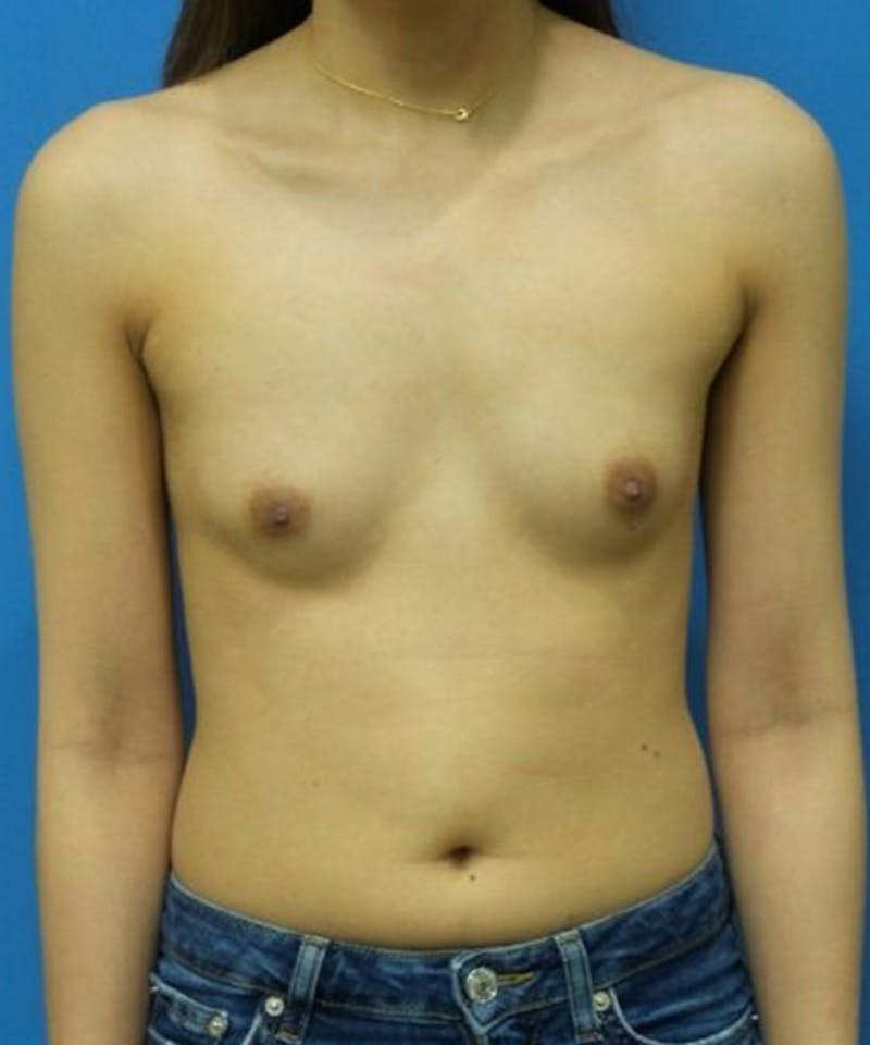 Breast Augmentation Before & After Gallery - Patient 496566 - Image 1