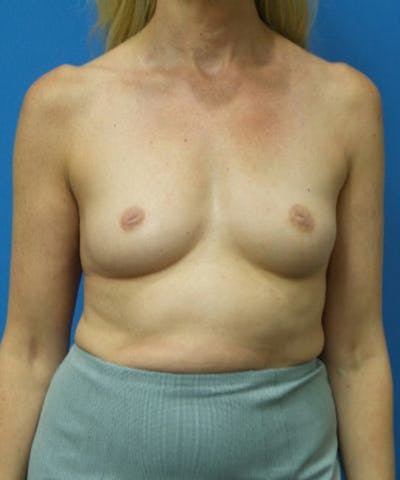 Breast Augmentation Before & After Gallery - Patient 993157 - Image 1