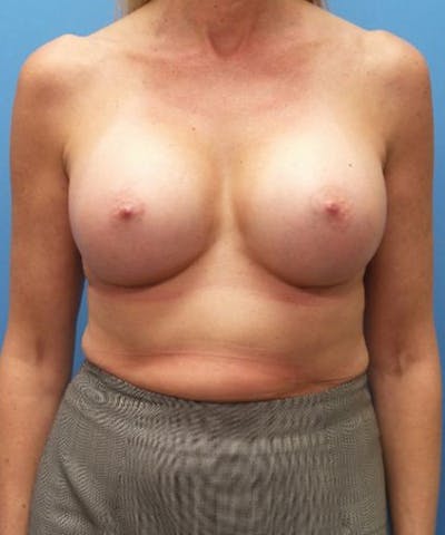 Breast Augmentation Before & After Gallery - Patient 993157 - Image 2