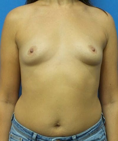 Breast Lift Before & After Gallery - Patient 182762 - Image 1