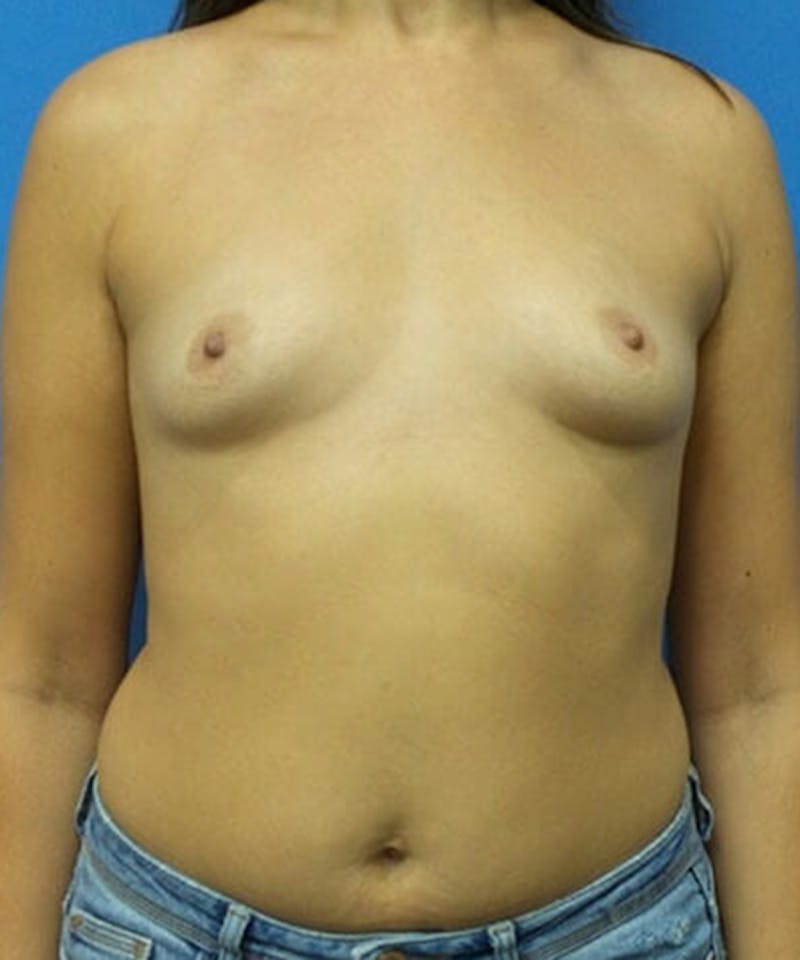 Breast Augmentation Before & After Gallery - Patient 489941 - Image 1